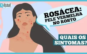Rosácea: o que é e quais são os sintomas