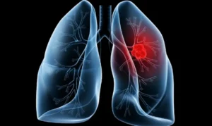 Saiba o que é adenocarcinoma pulmonar, câncer que atinge o papa